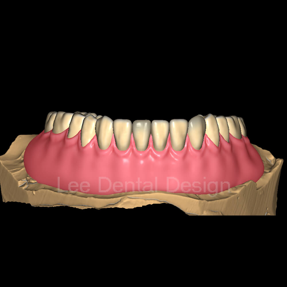 Acrylic Denture Design 3