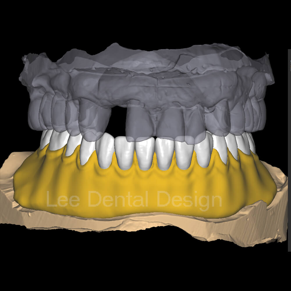 Acrylic Denture Design 1