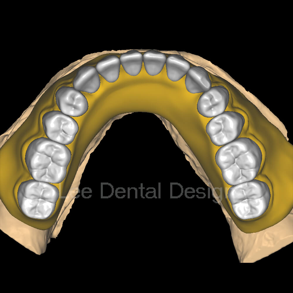 Acrylic Denture Design 2