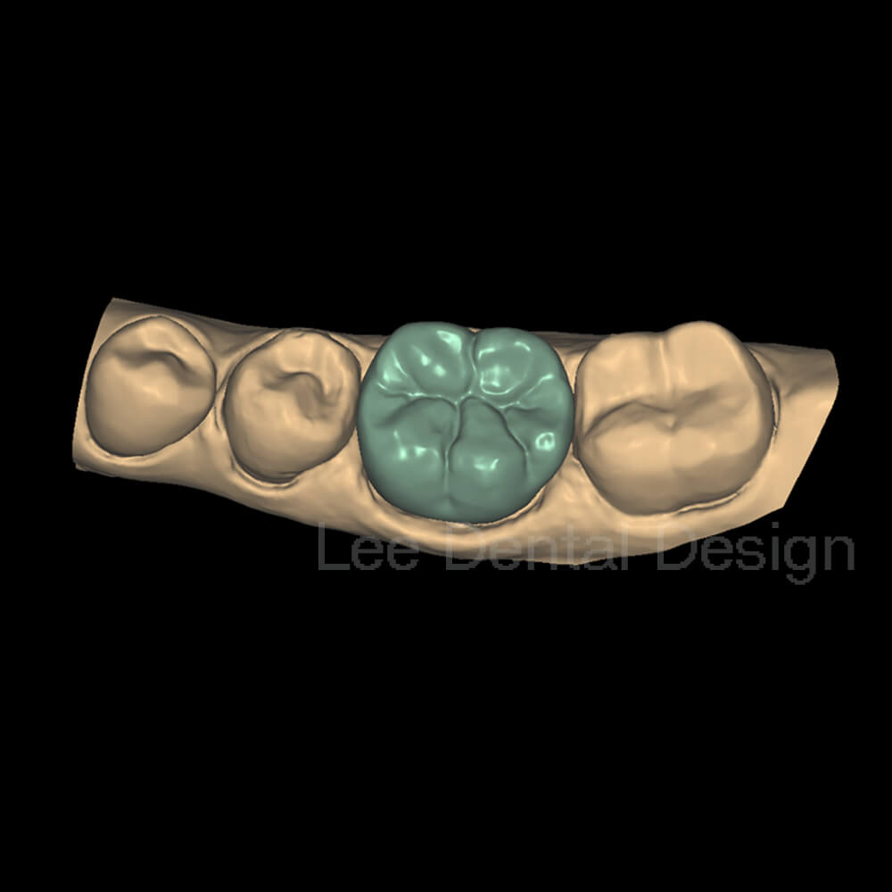 Crown & Bridge Design 3