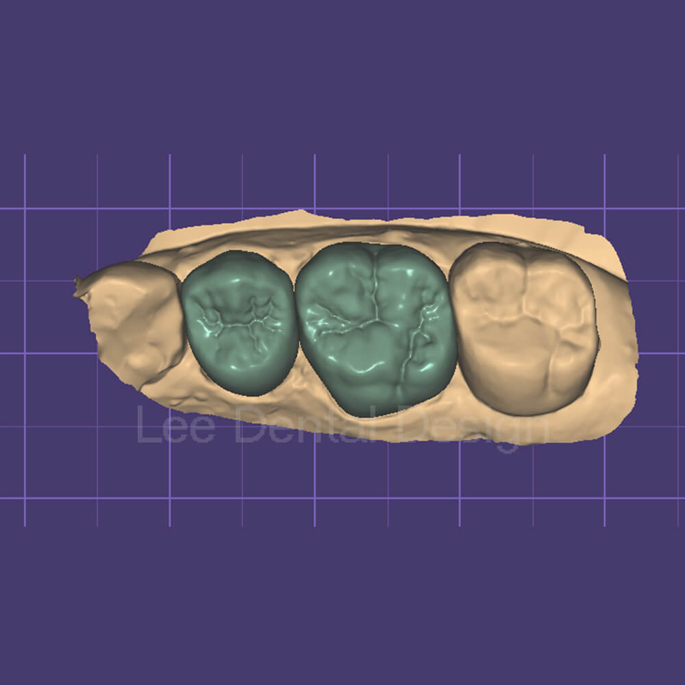 Crown & Bridge Design 1