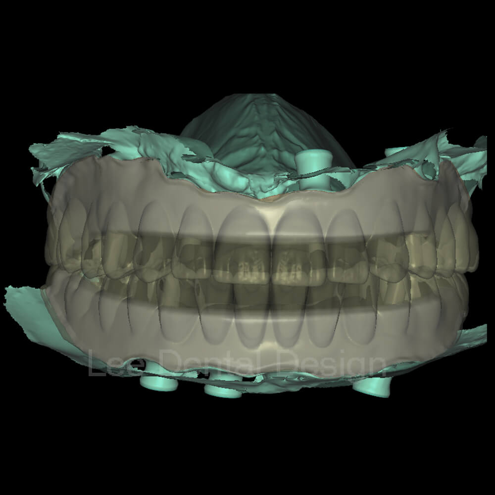 Impant Bar Design 6
