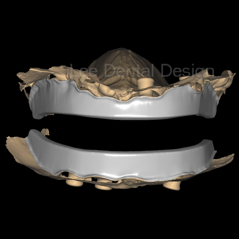 Impant Bar Design 7