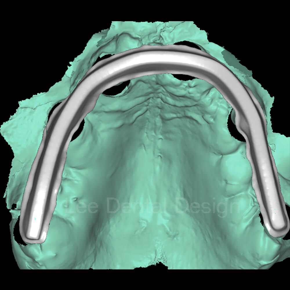 Impant Bar Design 9