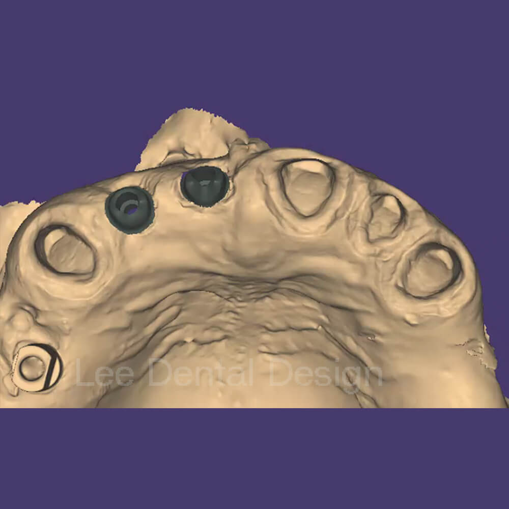 Custom Abutment Design 3