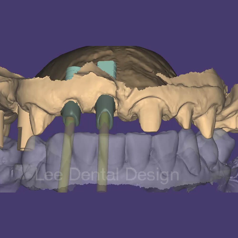 Custom Abutment Design 4