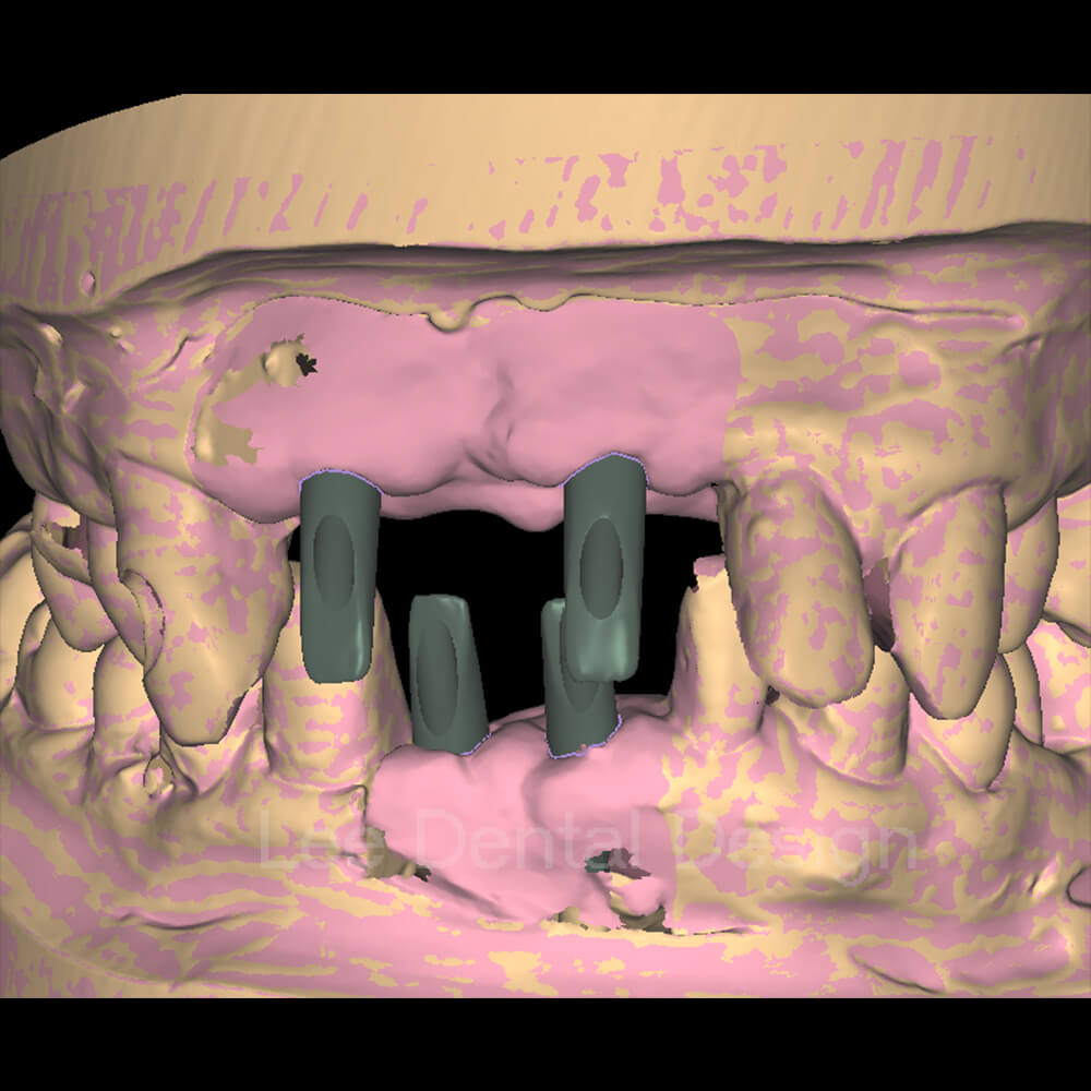 Custom Abutment Design 1