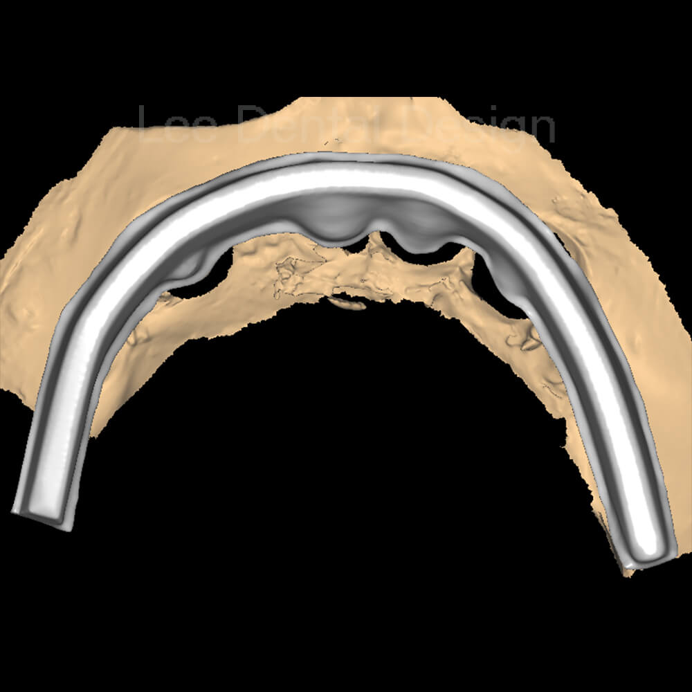 Impant Bar Design 10