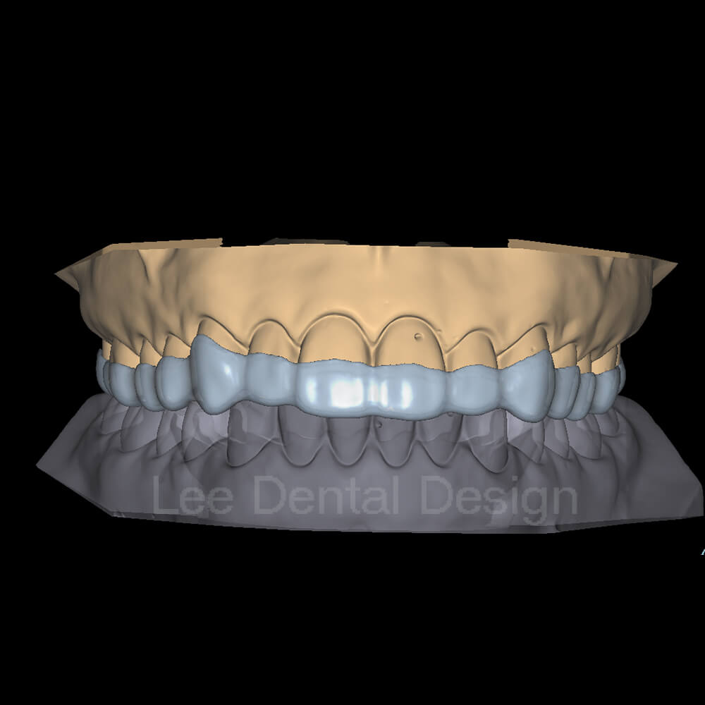 Splint Design 1