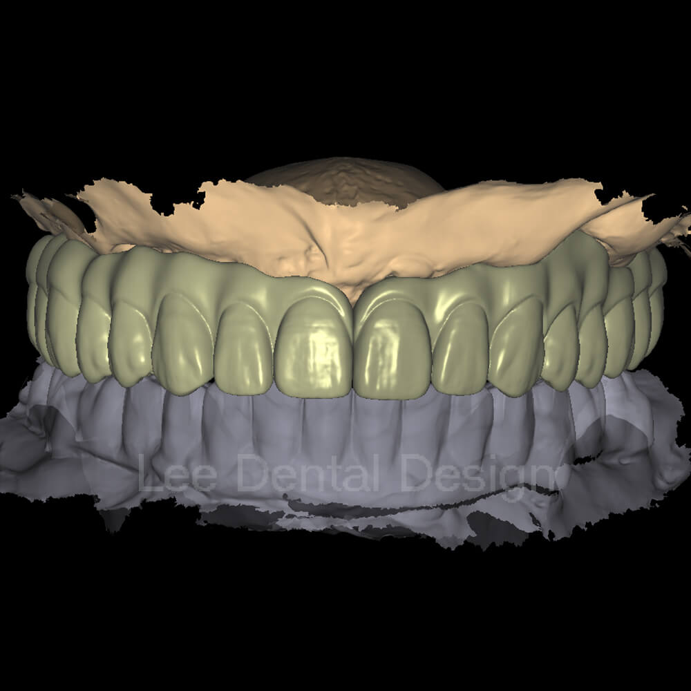 Screw Crown & Bridge Design 5