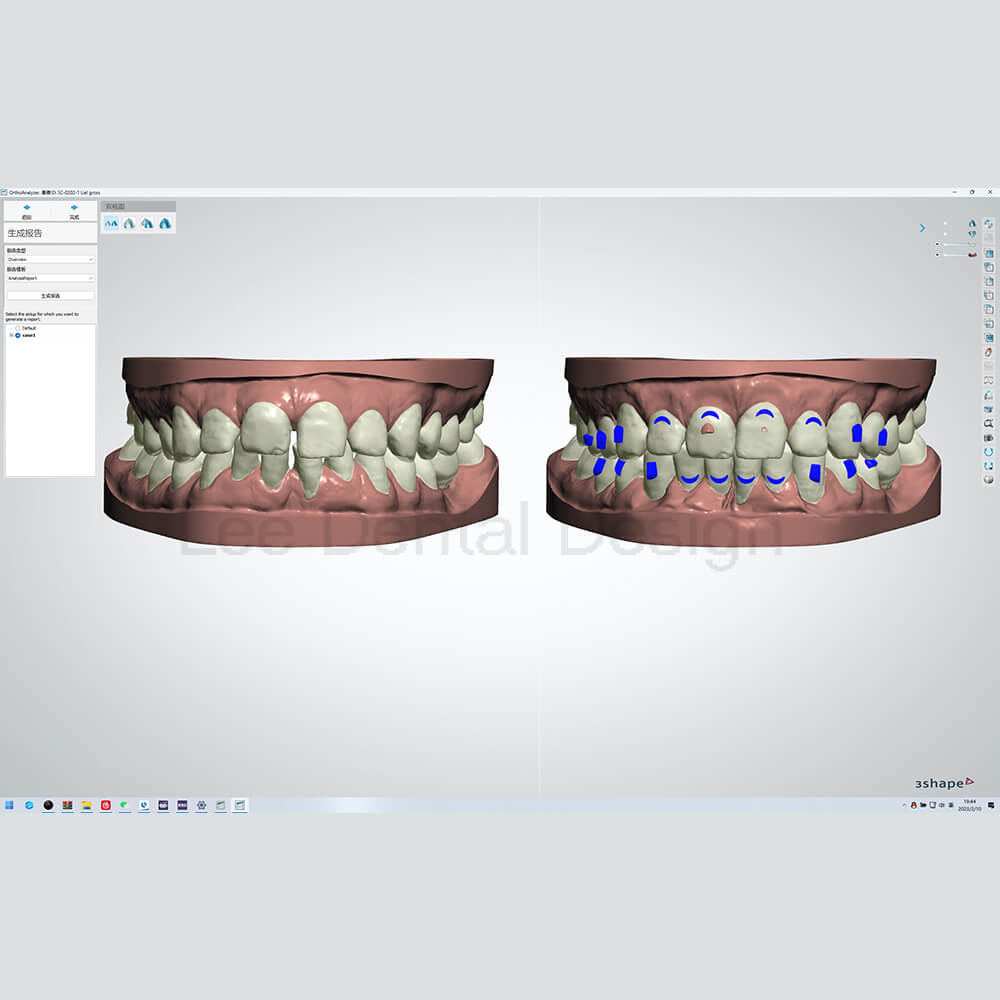 Invisible Align Treatment Plan 3