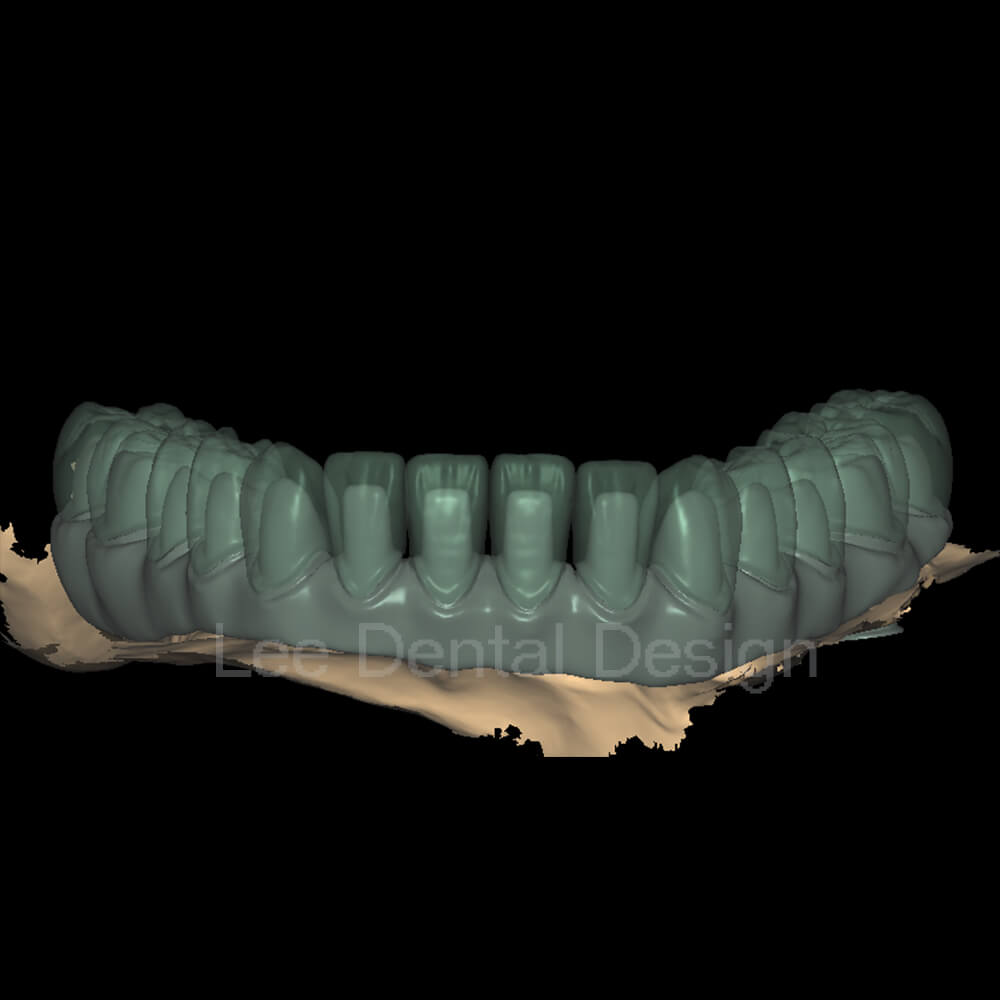 All-on-x Bridge Design 9