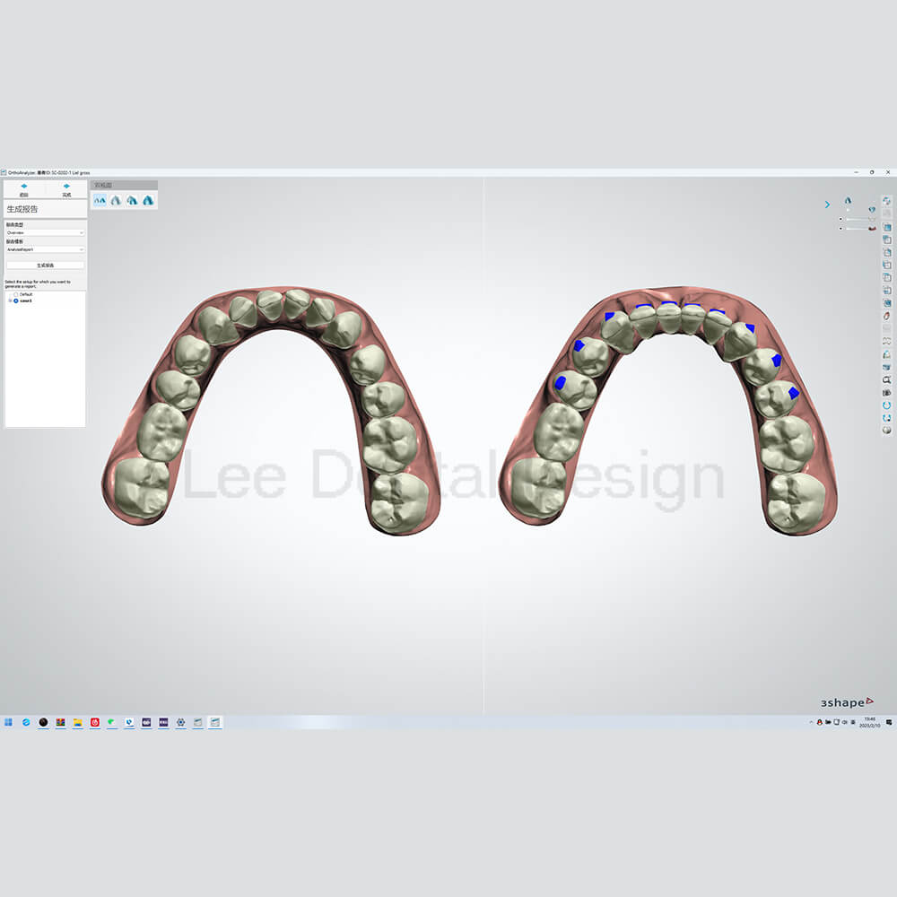 Invisible Align Treatment Plan 4
