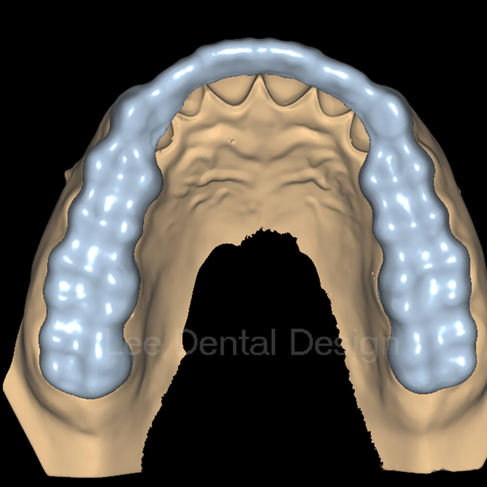 Splint Design 3