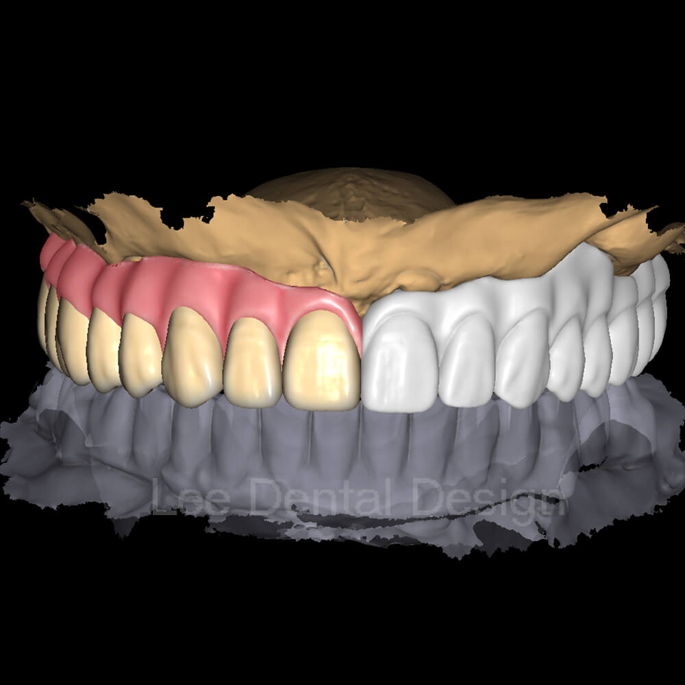 Screw Crown & Bridge Design 3