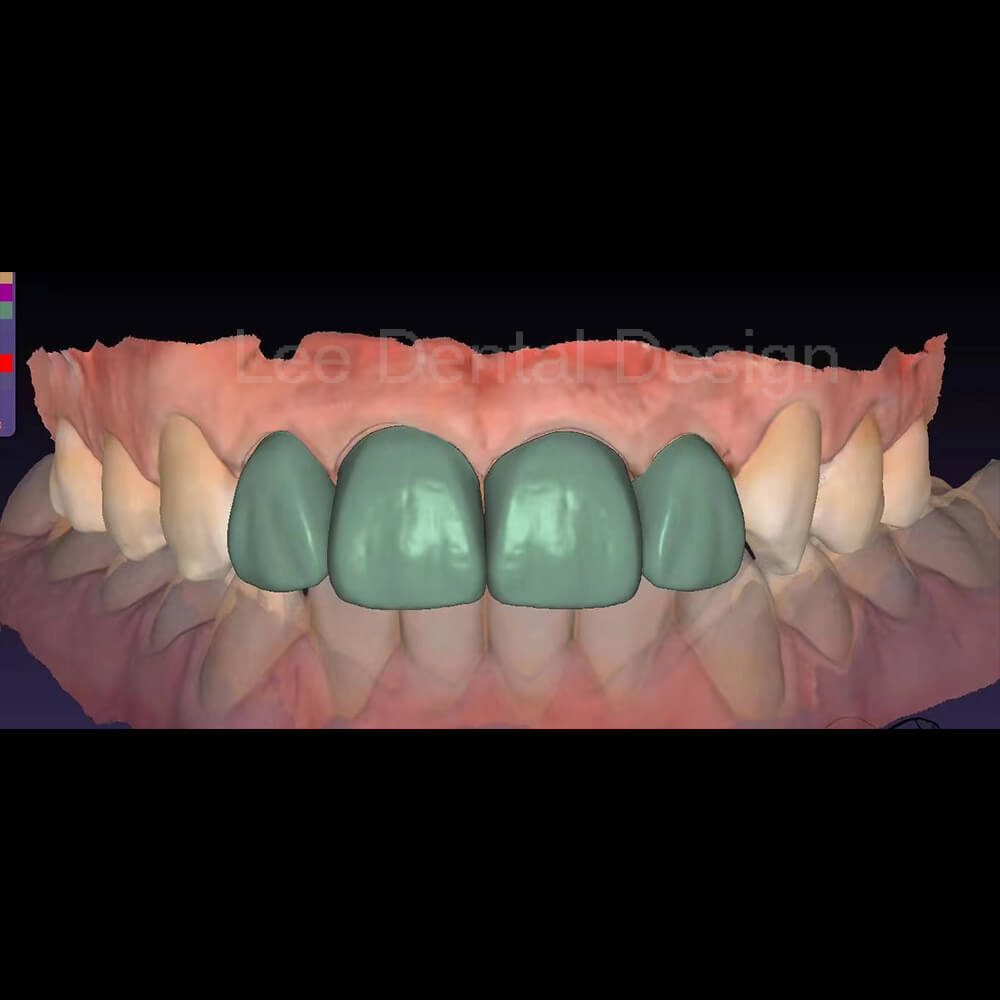 Veneer Design 1