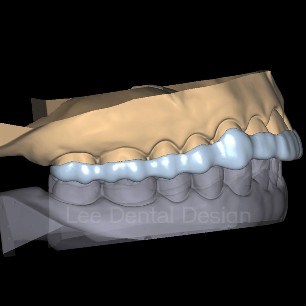 Splint Design 2