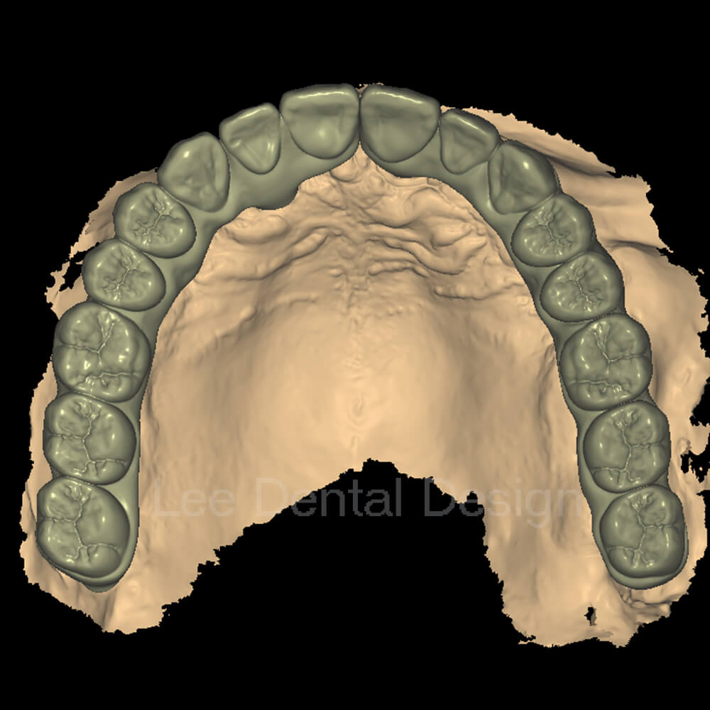 Screw Crown & Bridge Design 4