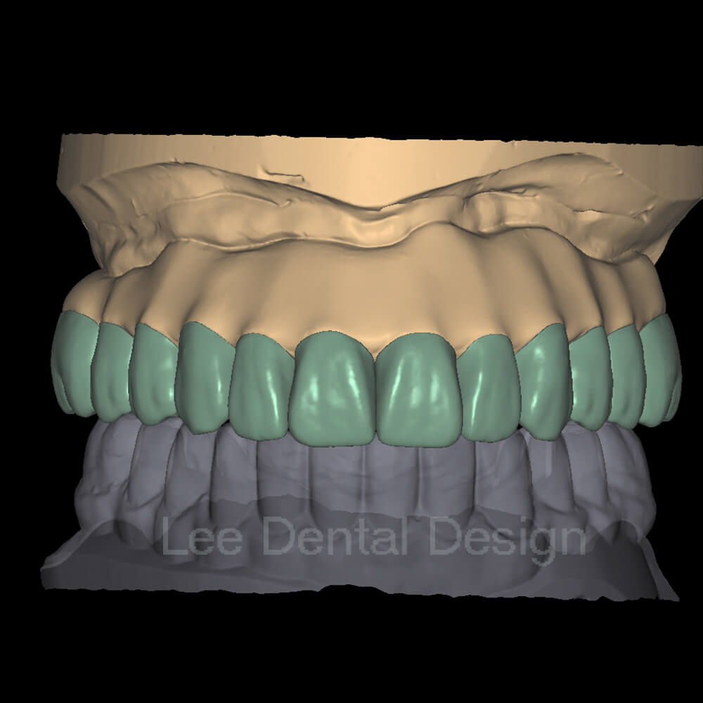 Screw Crown & Bridge Design 2