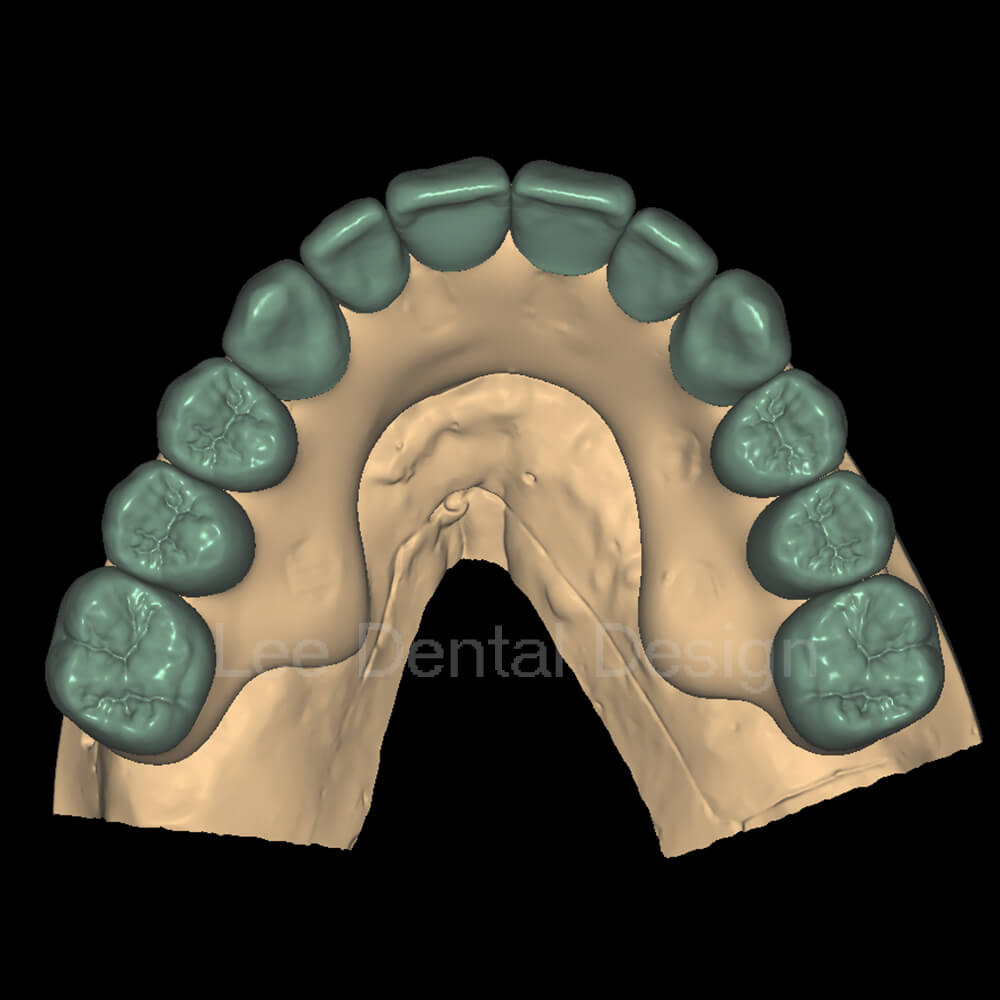 Screw Crown & Bridge Design 1
