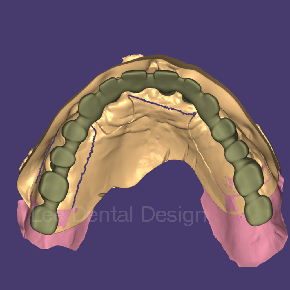Do you know the advantages and disadvantages of removable dentures and how